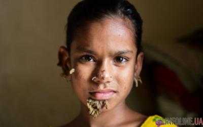 Девочку-дерево обнаружили в Бангладеш