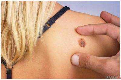 Как распознать рак кожи и уберечься от него