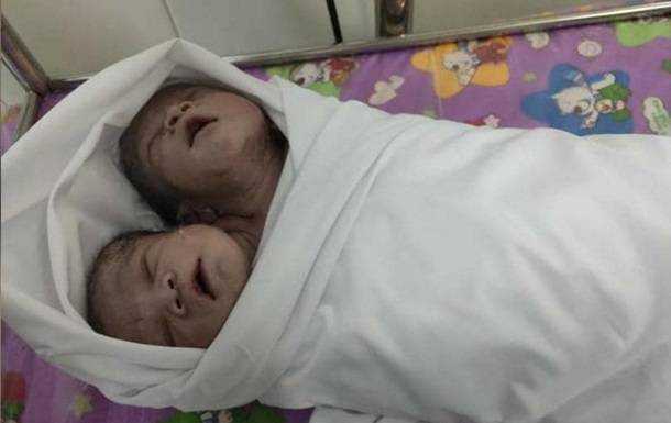 В Мьянме родился двухголовый мальчик