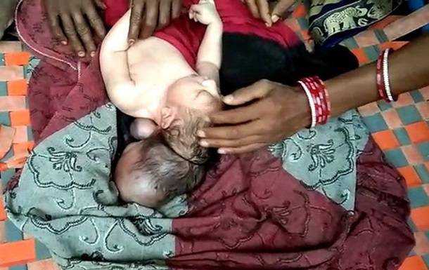 В Індії народилося триголове немовля