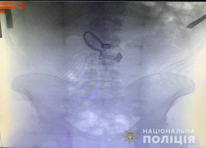 В Киеве поймали грабителя: краденое нашли в желудке