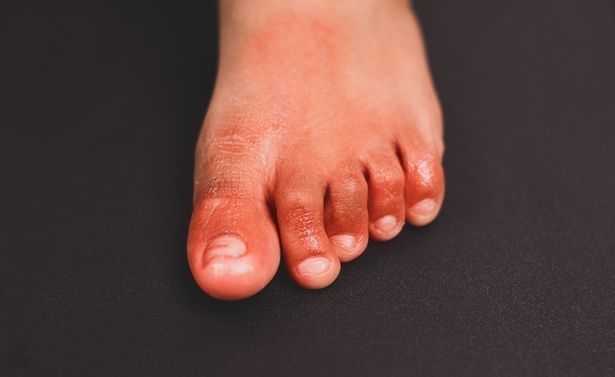 Вчені виявили новий симптом COVID, який нагадує обмороження ніг