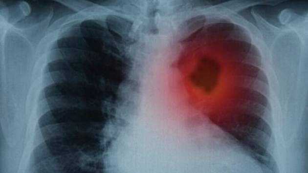 Онкологи назвали первые симптомы рака легких