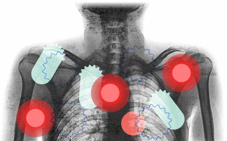 Как коронавирус атакует кровь, легкие и сердце – ученые
