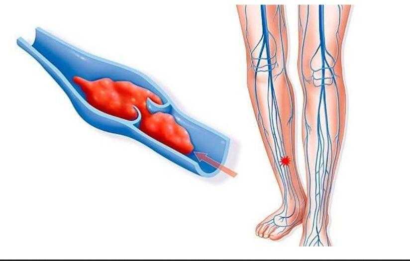 Тромбы в сосудах: врачи назвали начальные симптомы