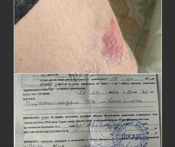 Киевлянка на почте хотела пройти без очереди и покусала мужчину