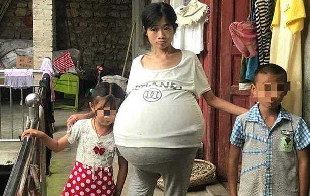 У китаянки неожиданно вырос 20-килограммовый живот