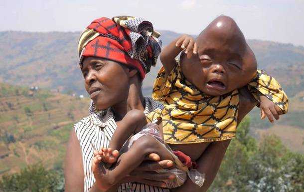 У Руанді жінка народила дитину з головою у формі груші