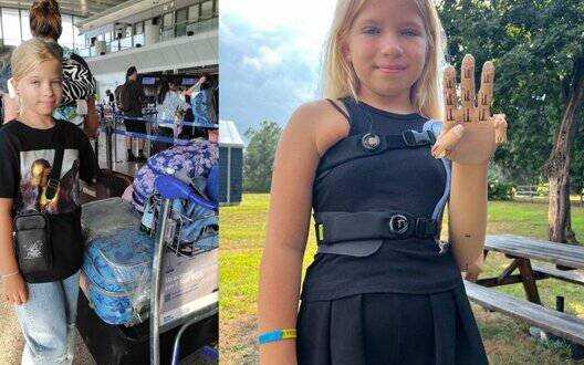 Зеленська показала дівчинку, яка втратила руку в Бучі і отримала унікальний протез у США